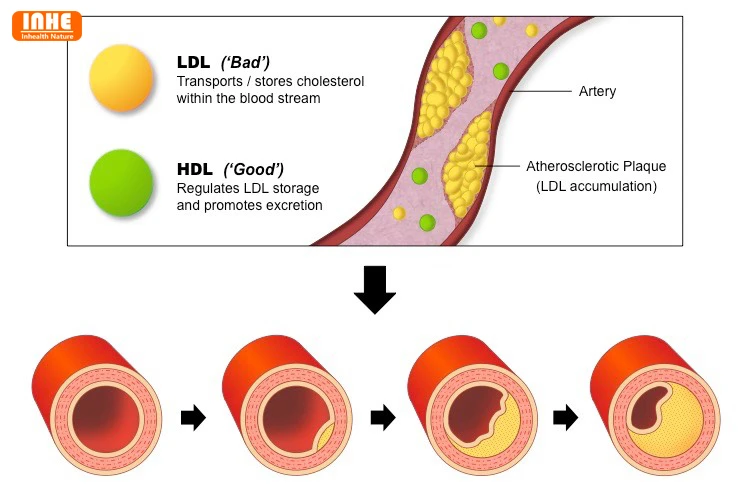 Atherosclerotic Plaque Atherosclerotic Plaque